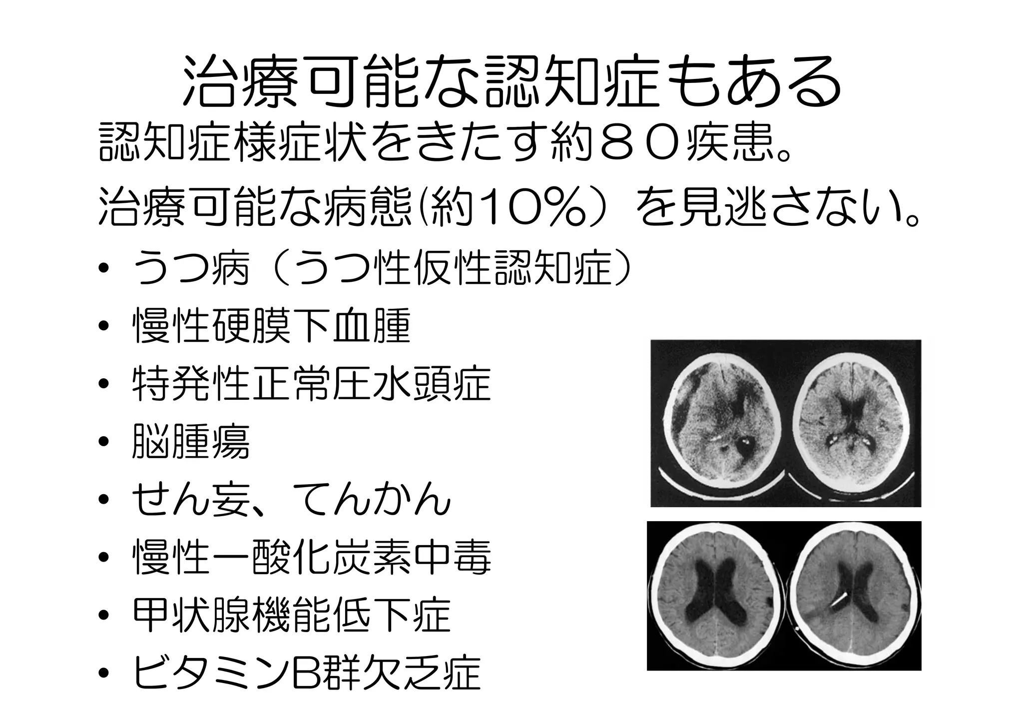 治療可能な認知症もある
認知症様症状をきたす約８０疾患。
治療可能な病態(約10％）を見逃さない。
•  うつ病（うつ性仮性認知症）
•  慢性硬膜下血腫
•  特発性正常圧水頭症
•  脳腫瘍
•  せん妄、てんかん
•  慢性一酸化炭素中毒
•  甲状腺機能低下症
•  ビタミンB群欠乏症
 