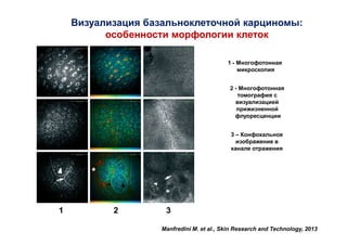 Визуализация базальноклеточной карциномы:
особенности морфологии клеток
1 - Многофотонная
микроскопия
2 - Многофотонная
томография с
визуализацией
прижизненной
флуоресценции
3 – Конфокальное
изображение в
канале отражения

1

2

3
Manfredini M. et al., Skin Research and Technology, 2013

 