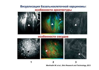 Визуализация базальноклеточной карциномы:
особенности архитектуры

особенности сосудов

1

2

3

Manfredini M. et al., Skin Research and Technology, 2013

 