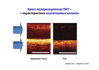 Кросс-поляризационная ОКТ –
+ характеристика коллагеновых волокон

Кросс-канал

Прямой канал

Здоровая ткань

Рак
Gladkova N.D., J. Biophoton. (2011)

 