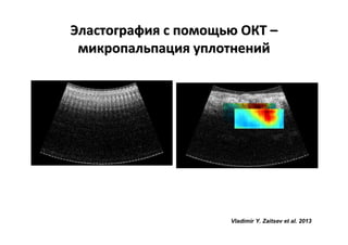 Эластография с помощью ОКТ –
микропальпация уплотнений

Vladimir Y. Zaitsev et al. 2013

 