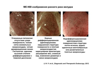 ME-NBI изображения раннего рака желудка

Угнененные патологии:
отсутствие узора
поверхности, тонкая
сетка аномальных
микрососудов, четкая
демаркационная линия.
Гистология: аденома
высокой степени
дифференцировки с
тяжелой дисплазии

Хорошо
Недифференцированная
дифференцированная
аденокарцинома:
аденокарцинома:
поверхностная структура
нарушенная структура
почти исчезла, видны
поверхности и плотная
единичные винтообразные
микрососудистая
или разветвленные
нерегулярная архитектура:
толстые микрососуды
расширение вен, сложный
ход, изменения диаметра и
связи микрососудов
Li H.-Y. et al., Diagnostic and Therapeutic Endoscopy. 2012

 