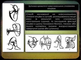 Спосіб
заснований
на
максимальному
згинанні кінцівки в суглобі, розташованому вище
рани
(в
результаті
чого
стискається
магістральна судина), та послідуючій фіксації
кінцівки в цьому положенні бинтом, паском або
іншого матеріалу (можна використовувати
завернутий рукав або штанину).

 