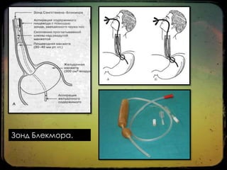 Зонд Блекмора.

 