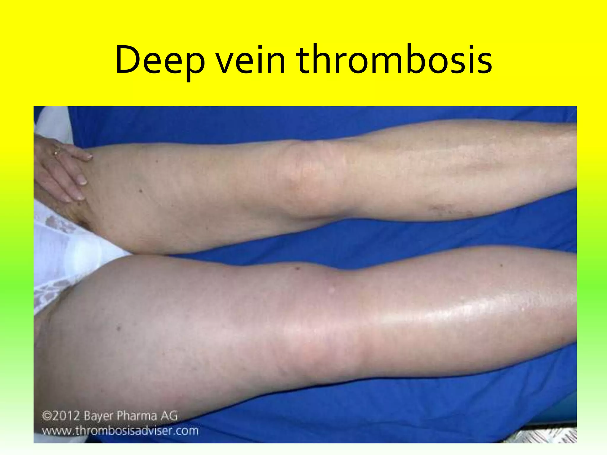 Deep vein thrombosis

 