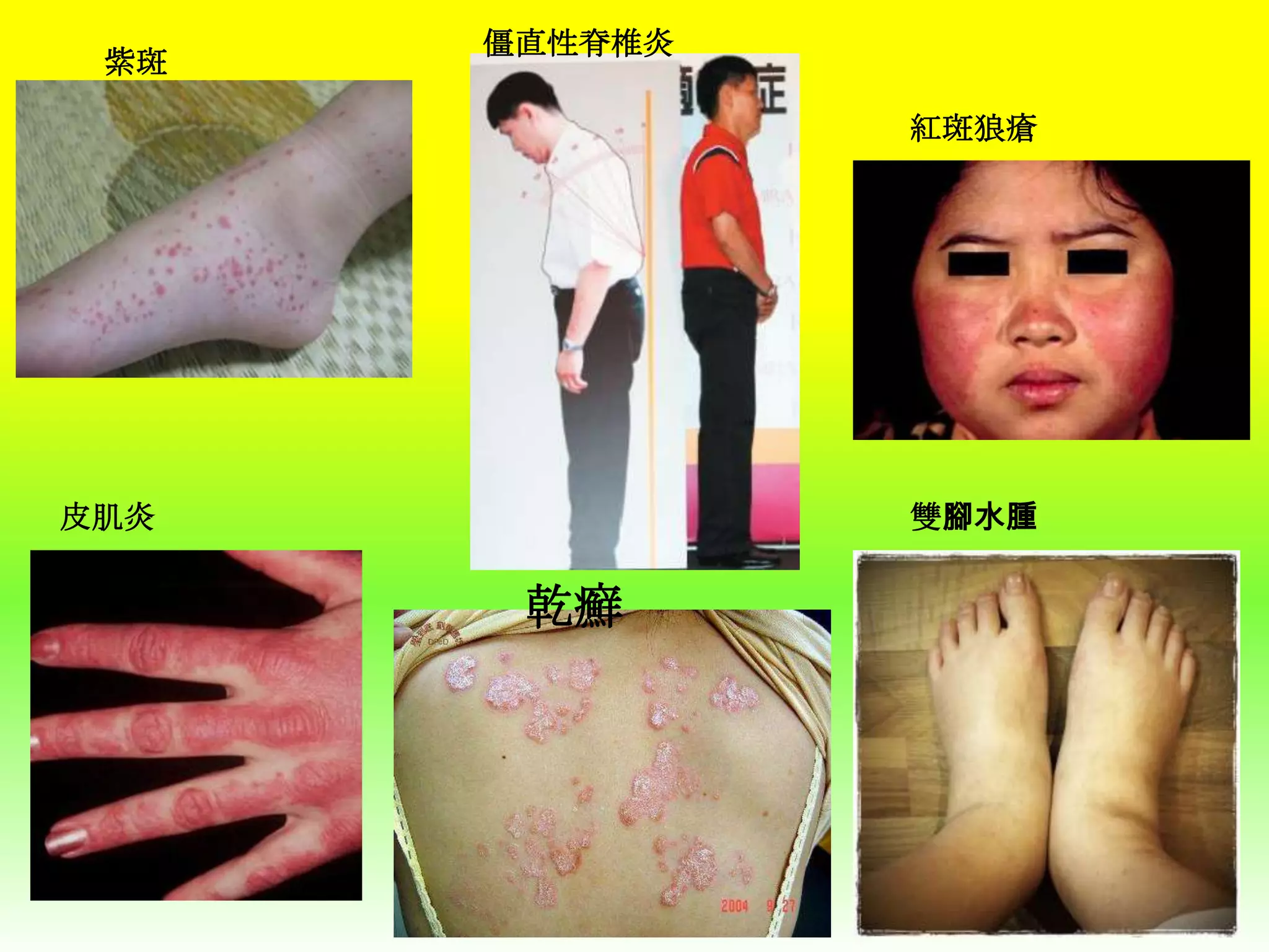 紫斑

僵直性脊椎炎
紅斑狼瘡

皮肌炎

雙腳水腫

乾癬

 