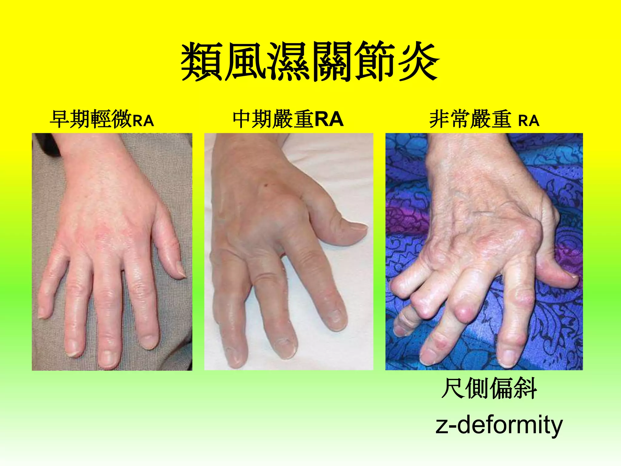 類風濕關節炎
早期輕微RA

中期嚴重RA

非常嚴重 RA

尺側偏斜

z-deformity

 