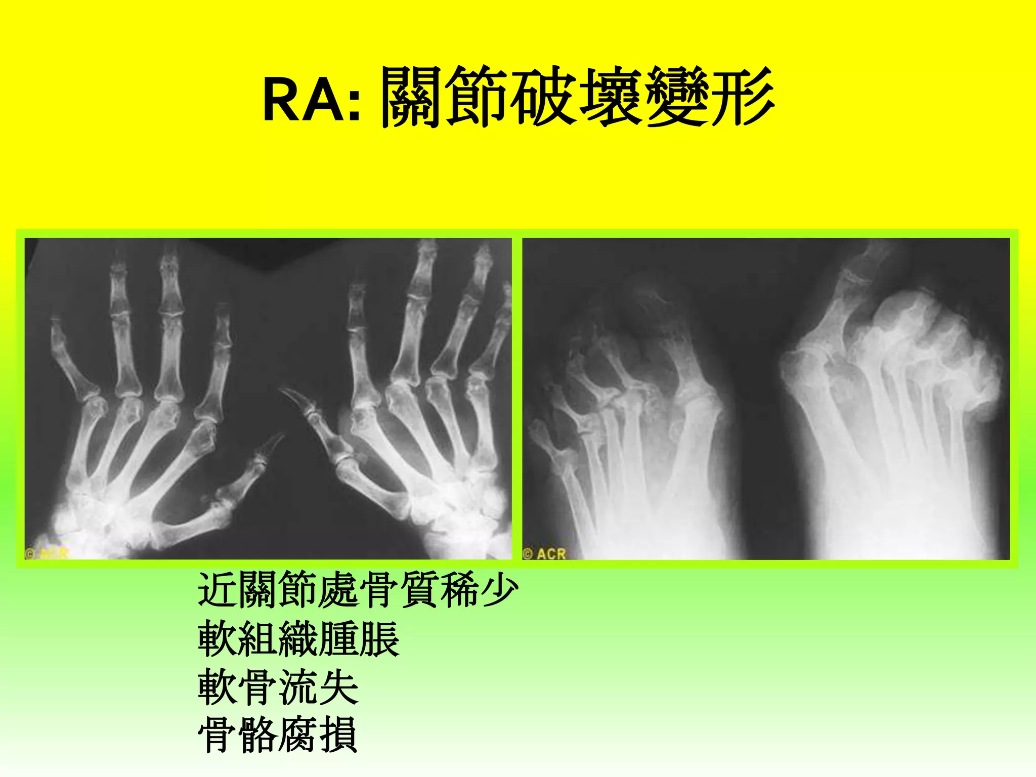RA: 關節破壞變形

Hands

Feet

近關節處骨質稀少
軟組織腫脹
軟骨流失
骨骼腐損

 