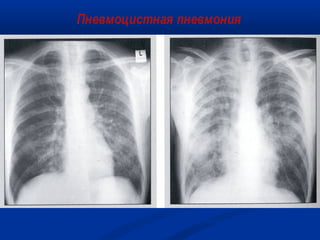 Пневмоцистная пневмония

Из коллекции слайдов UCHSC AETC

 