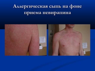Аллергическая сыпь на фоне
приема невирапина

 