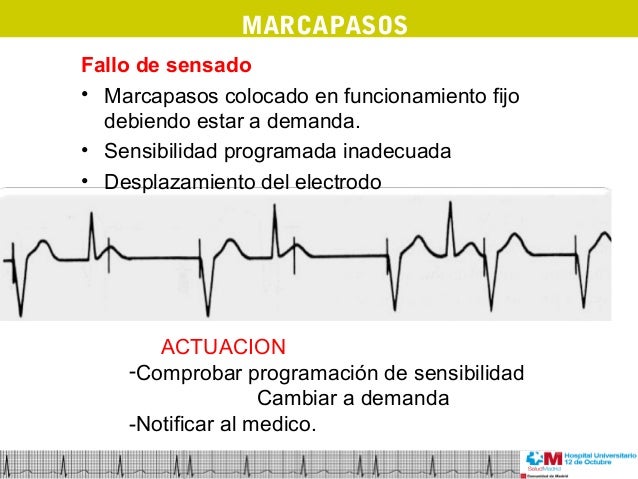 ecg-d-a-4-marcapasos