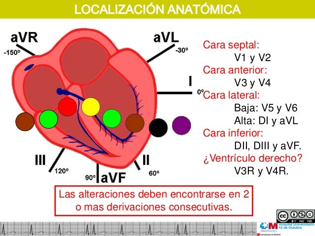 ECG. Día 5. Síndrome Coronario Agudo