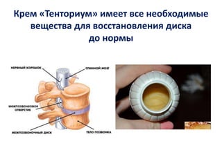 Крем «Тенториум» имеет все необходимые
вещества для восстановления диска
до нормы

 
