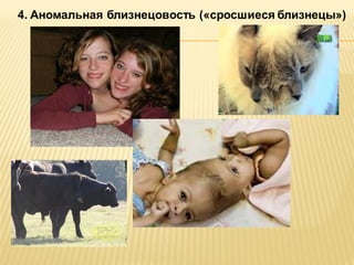 4. Аномальная близнецовость («сросшиеся близнецы»)

 