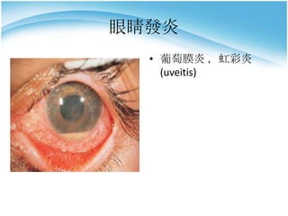 眼睛發炎
• 葡萄膜炎 ，虹彩炎
(uveitis)

 