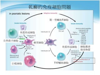 乾癬的免疫細胞問題
in psoriatic lesions
第一型輔助T細胞

角質形成細胞
自然殺手細胞

樹突細胞
角質形成細胞

巨噬細胞

T17輔助細胞

細胞激素
發炎物質

induces proliferation of
keratinocytes

 