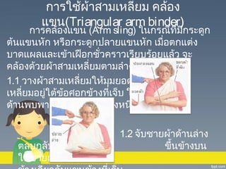การใช้ผ้าสามเหลียม คล้อง
่
แขน(Triangular arm binder)

การคล้องแขน (Arm sling) ในกรณีที่มีกระดูก
ต้นแขนหัก หรือกระดูกปลายแขนหัก เมื่อตกแต่ง
บาดแผลและเข้าเฝือกชัวคราวเรียบร้อยแล้ว จะ
่
คล้องด้วยผ้าสามเหลี่ยมตามลำาดับดังนี้
1.1 วางผ้าสามเหลี่ยมให้มุมยอดของสาม
เหลี่ยมอยู่ใต้ข้อศอกข้างที่เจ็บ ให้ชายผ้า
ด้านพบพาดไปที่ไหล่อีกข้างหนึ่ง

ตลบกลับ
ให้ชายผ้าพาดไปที่ไหล่

1.2 จับชายผ้าด้านล่าง
ขึ้นข้างบน

 