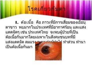 โรคเกี่ย วกับ ตา
1. ต้อ เนือ คือ ภาวะที่มีการเสือมของเยื่อบุ
้
่
ตาขาว พบมากในประเทศที่มีอากาศร้อน และแสง
แดดจัดๆ เช่น ประเทศไทย จะพบผู้ปวยที่เป็น
่
ต้อเนื้อกันมากโดยเฉพาะในสังคมชนบทที่มี
แสงแดดจัด ลมแรง จะพบว่าผูทำาไร่ ทำาสวน ทำานา
้
เป็นต้อเนื้อกันมา

 