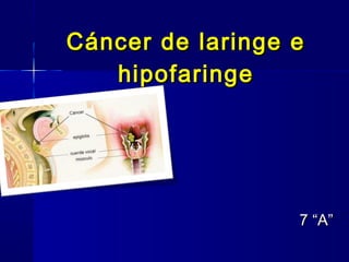 Cáncer de laringe e
hipofaringe

7 “A”

 