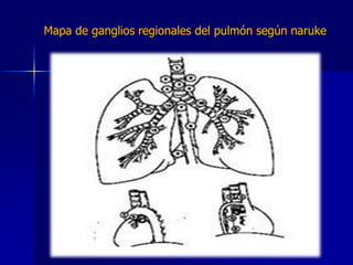 Mapa de ganglios regionales del pulmón según naruke

 