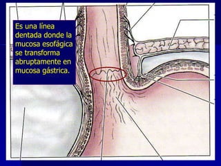 Es una  La UNIÓN ESOFAGOGÁSTRICA.- se sitúa
línea
dentada dondeizq. De la vértebra T11 en el plano
a la la
mucosa esofágica
horizontal que pasa a través de la punta
se transforma
de la apófisis xifoides.
abruptamente en
mucosa gástrica.

Los cirujanos y los endoscopistas
denominan a la unión:
ESOFAGOGÁSTRICA como línea Z.



 