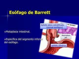 Esófago de Barrett
Epitelio plano estratificado.
(normal esofágico)
Metaplasia
Específica

intestinal.

del segmento inferior
del esófago.

Reemplazo
por

epitelio cilíndrico

 