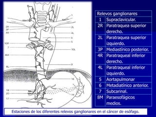 Relevos ganglionares
1 Supraclavicular.
2R Paratraquea superior
derecho.
2L Paratraquea superior
izquierdo.
3P Mediastínico posterior.
4R Paratraqueal inferior
derecho.
4L Paratraqueal inferior
izquierdo.
5 Aortapulmonar
6 Metadiatínico anterior.
7 Subcarinal.
8M Paraesofágicos
medios.


Estaciones de los diferentes relevos ganglionares en el cáncer de esófago.

 