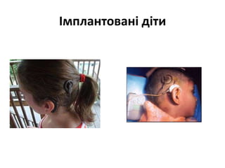 Імплантовані діти

 