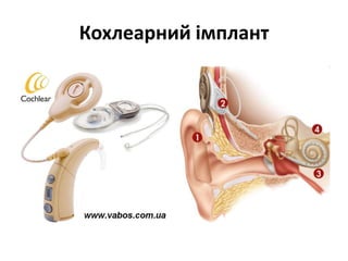 Кохлеарний імплант

 