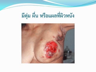 มีตุ่ม ผื่น หรือแผลที่ผิวหนัง

 