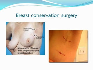 Breast conservation surgery

 