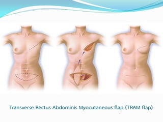 Transverse Rectus Abdominis Myocutaneous flap (TRAM flap)

 
