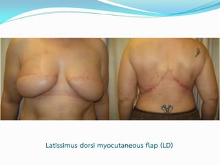 Latissimus dorsi myocutaneous flap (LD)

 