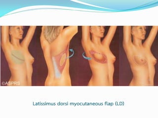 Latissimus dorsi myocutaneous flap (LD)

 