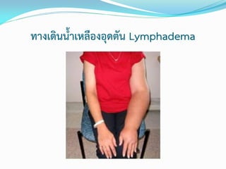 ทางเดินน้าเหลืองอุดตัน Lymphadema

 