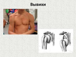 Вывихи

 