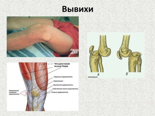 Вывихи

 