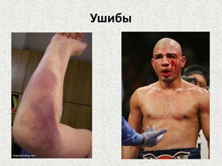 Ушибы

 
