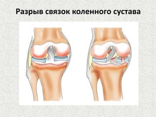 Разрыв связок коленного сустава

 