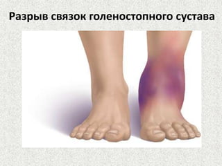 Разрыв связок голеностопного сустава

 
