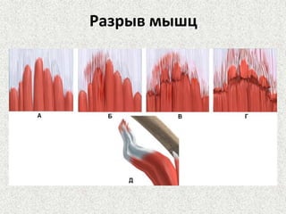 Разрыв мышц

 