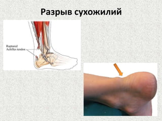 Разрыв сухожилий

 