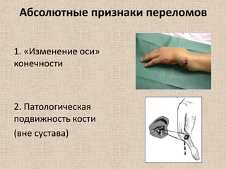 Абсолютные признаки переломов
1. «Изменение оси»
конечности

2. Патологическая
подвижность кости
(вне сустава)

 