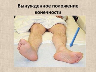 Вынужденное положение
конечности

 