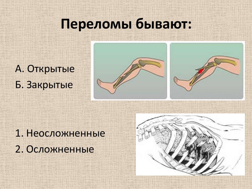 вывихи растяжения переломы. вывихи и переломы первая помощь. вывихи растяжения переломы. вывихи растяжения переломы.