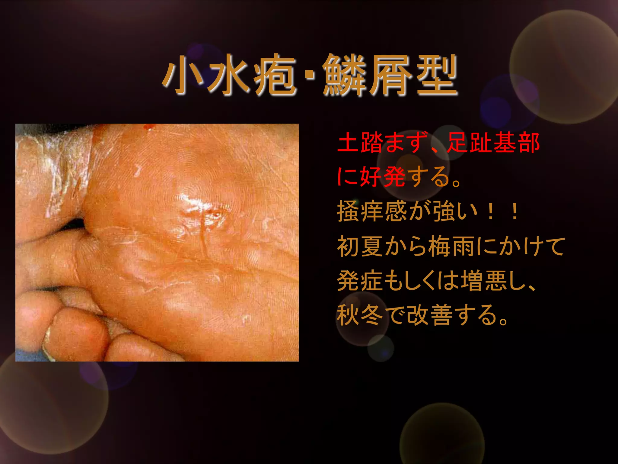 小水疱・鱗屑型	
土踏まず、足趾基部	
に好発する。	
掻痒感が強い！！	
初夏から梅雨にかけて	
発症もしくは増悪し、	
秋冬で改善する。	

 