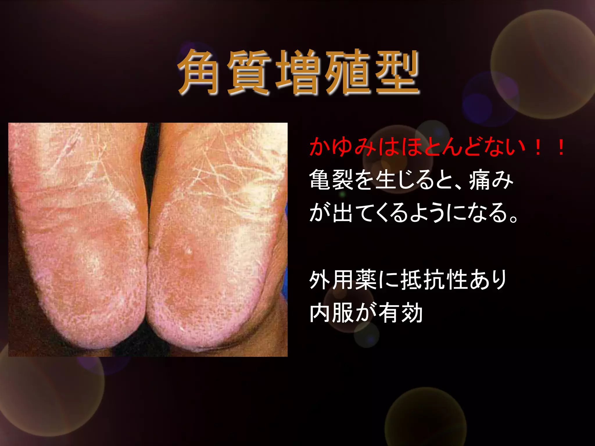 角質増殖型	
かゆみはほとんどない！！
亀裂を生じると、痛み
が出てくるようになる。
外用薬に抵抗性あり
内服が有効	

 