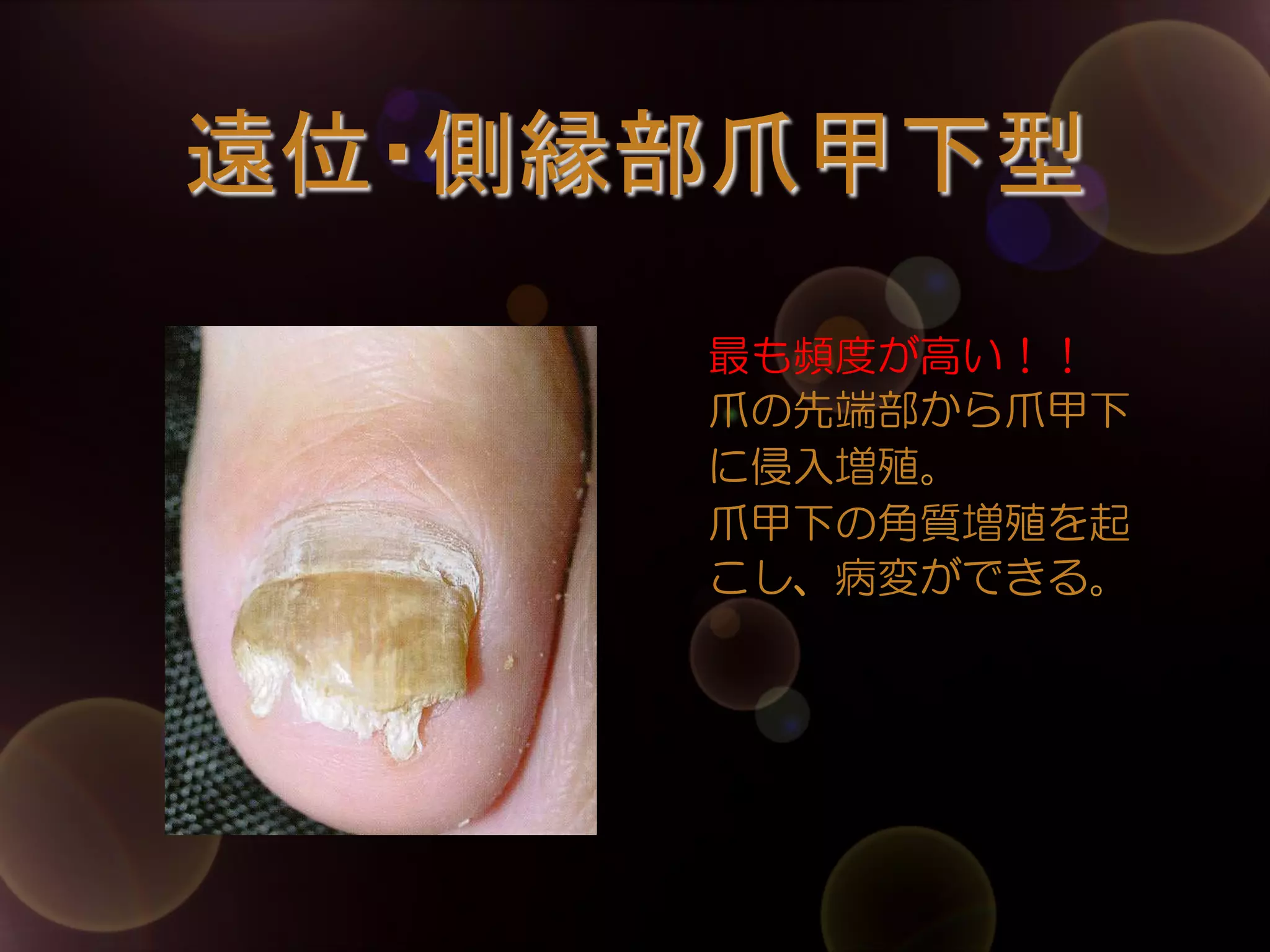 遠位・側縁部爪甲下型	
最も頻度が高い！！
爪の先端部から爪甲下
に侵入増殖。
爪甲下の角質増殖を起
こし、病変ができる。

 