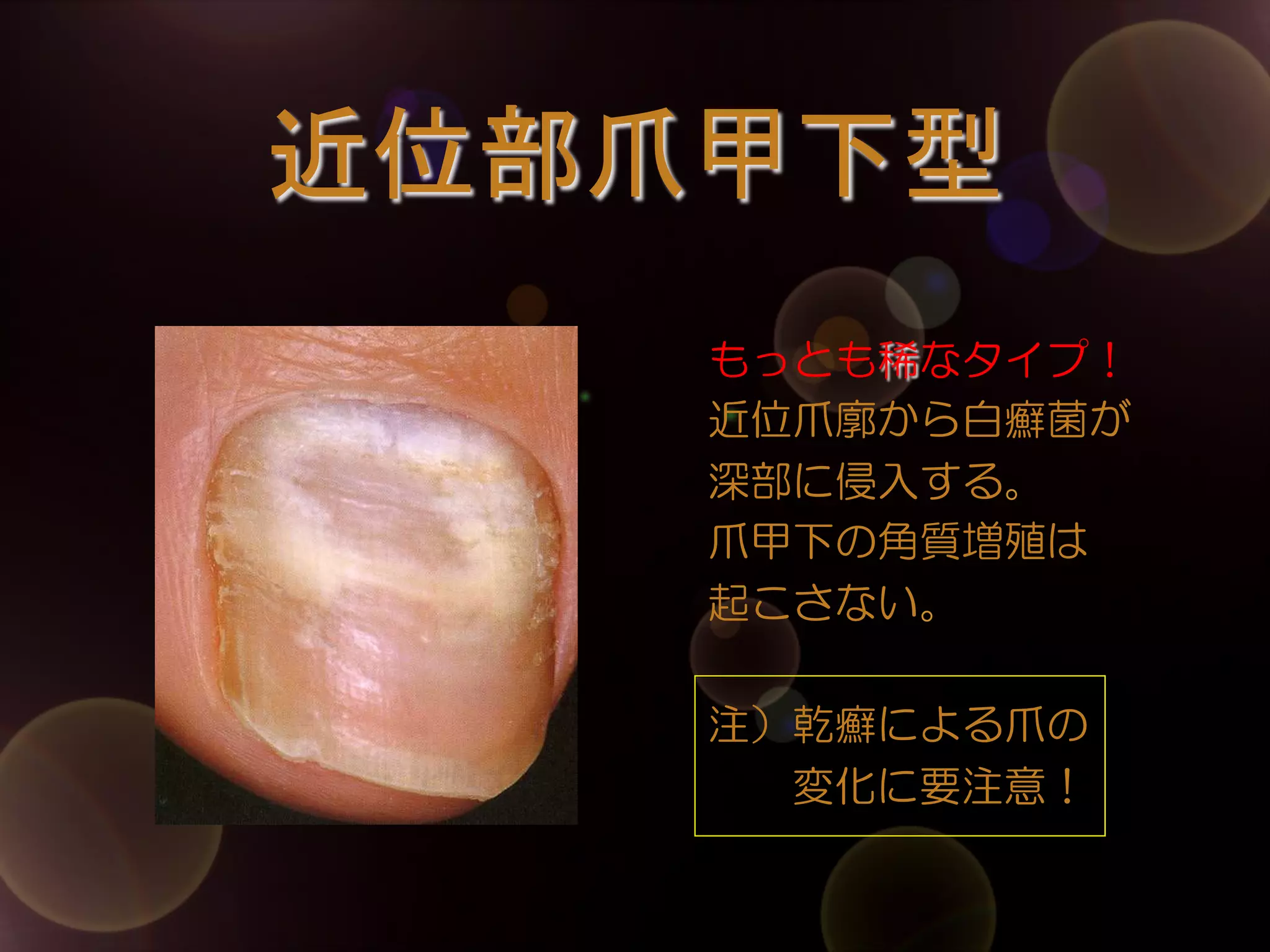 近位部爪甲下型	
もっとも稀なタイプ！
近位爪廓から白癬菌が
深部に侵入する。
爪甲下の角質増殖は
起こさない。
注）乾癬による爪の
            変化に要注意！

 
