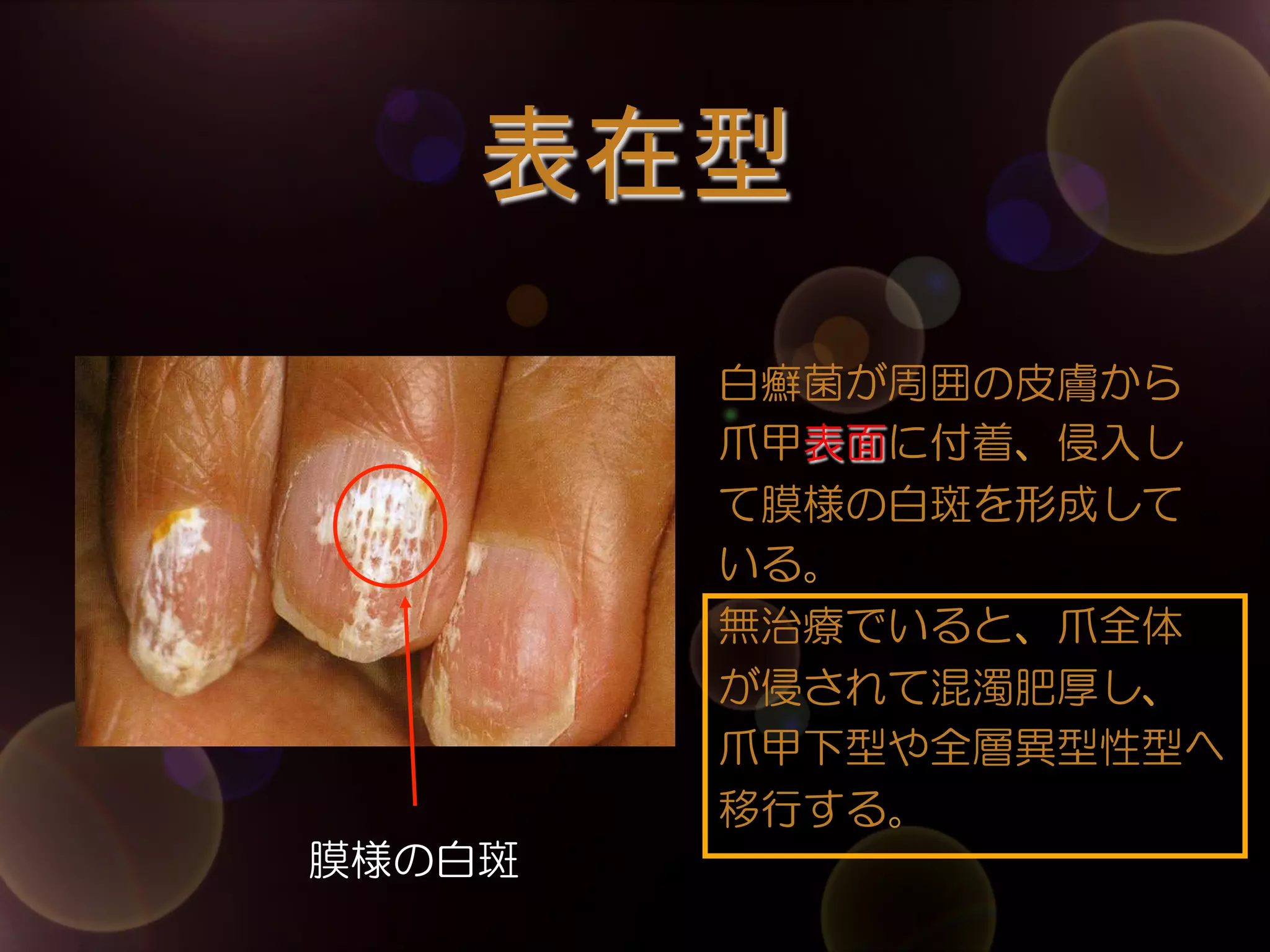 表在型	
白癬菌が周囲の皮膚から
爪甲表面に付着、侵入し
て膜様の白斑を形成して
いる。
無治療でいると、爪全体
が侵されて混濁肥厚し、
爪甲下型や全層異型性型へ
移行する。
膜様の白斑

 